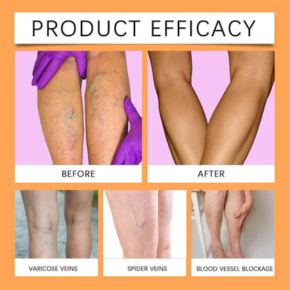 Turmeric Varicose Vein Relief Spray( BUY 1 GET 1 FREE💥 🎁  )