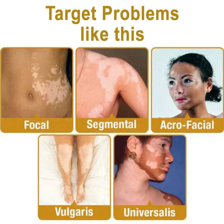 Venom Vitiligo Removal Cream Limited Time Only 💥Buy 1 Get 1 FREE 💥