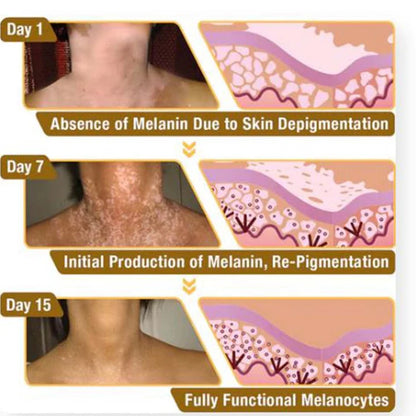 Venom Vitiligo Removal Cream Limited Time Only 💥Buy 1 Get 1 FREE 💥