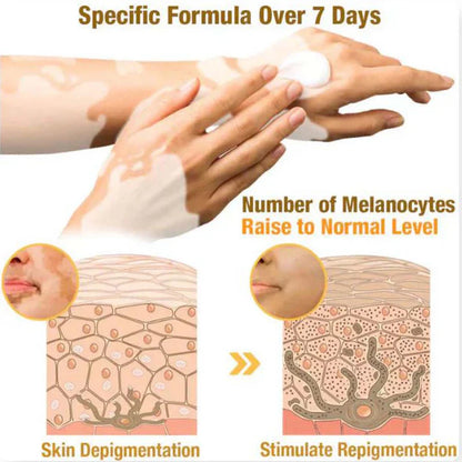 Venom Vitiligo Removal Cream Limited Time Only 💥Buy 1 Get 1 FREE 💥