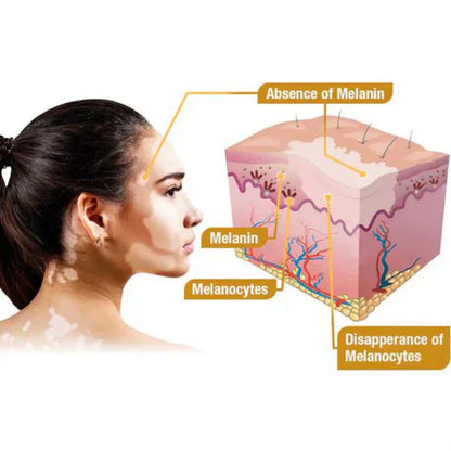 Venom Vitiligo Removal Cream Limited Time Only 💥Buy 1 Get 1 FREE 💥